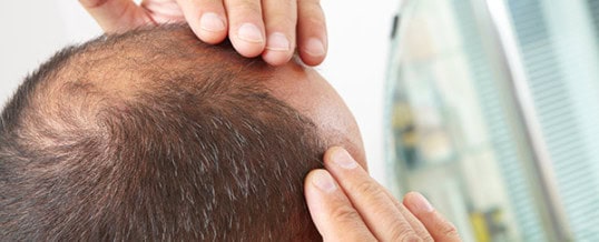 New Cell Therapies to Combat Hair Loss