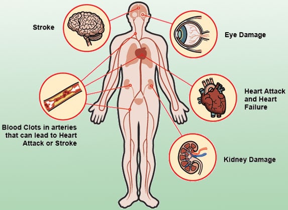 risks-and-complications-of-HBP