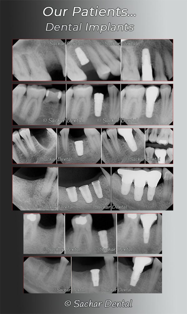 Dental implants NYC before and after pictures Picture of 6 before and after x-rays of our patients who had dental implants
