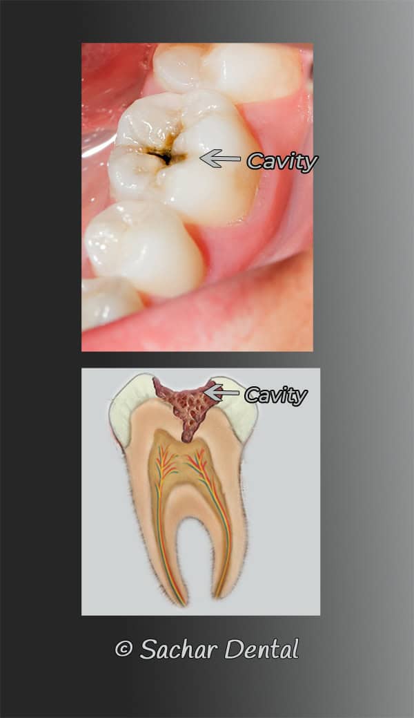 Dentist NYC cavities | Sachar Dental NYC Dentist NYC for cavity fillings