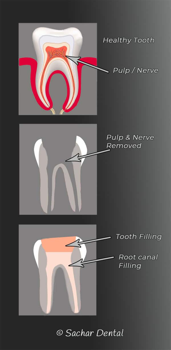 Dentist NYC root canal Dentist NYC- root canal diagram