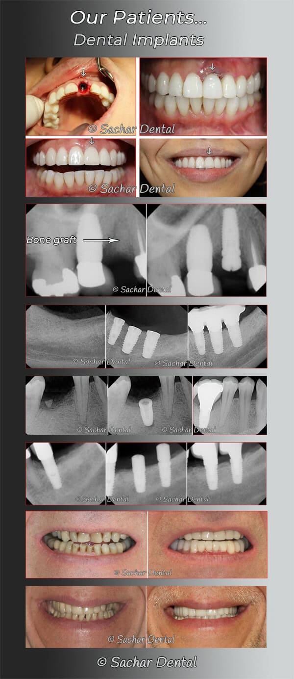 Dental implants NYC before and after pictures Picture description: Before and after picture of our patients with dental implants multiple patients with x-rays and clinical pictures