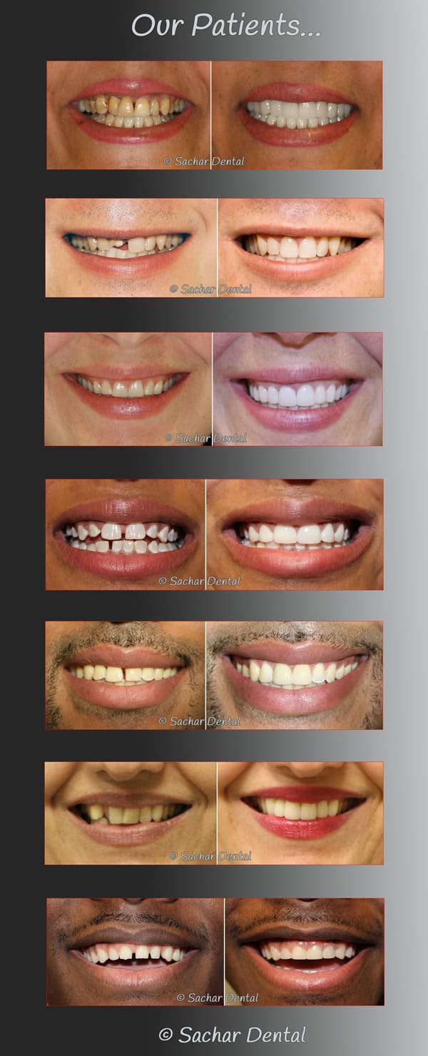 Sachar Dental NYC smile makeovers Smile Makeover NYC