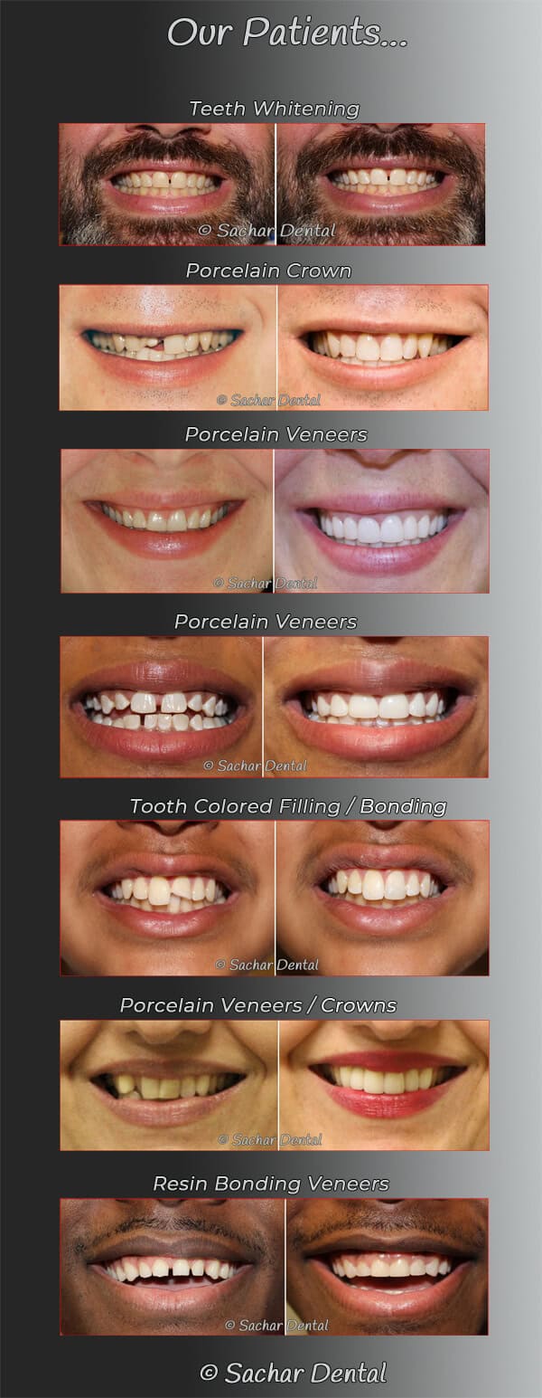 Resin Bonding Veneers NYC: Dr Sachar