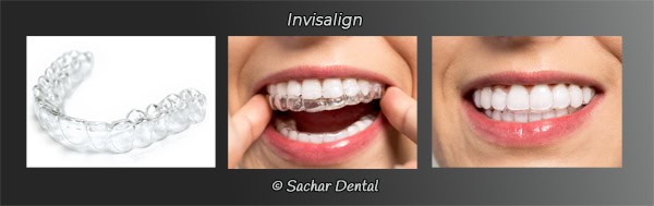 Dentist NYC for Invisalign Invisalign NYC
