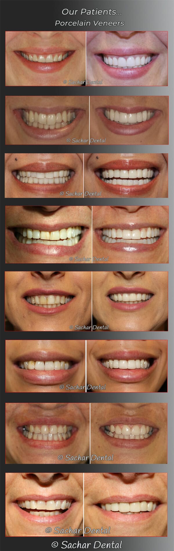 Top Cosmetic Dentist NYC for porcelain veneers Cosmetic Dentist NYC for Porcelain Veneers