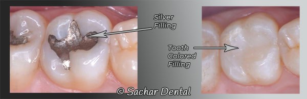 Dentist NYC cavity Fillings Dentist NYC for tooth colored fillings