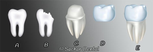 Diagram of Dental Crown Dentist NYC for dental crown- diagram