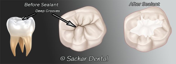 Dentist NYC sealants for teeth with deep grooves Dentist NYC for dental sealants