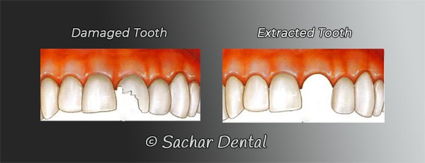 tooth extraction Dentist NYC for tooth extractions- diagram
