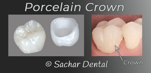 Dentist NYC porcelain crown cosmetic dentist Cosmetic Dentist NYC - porcelain Crown
