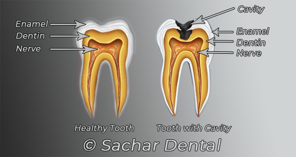 Dentist NYC for cavities | Sachar Dental NYC Dental Cavity fillings NYC