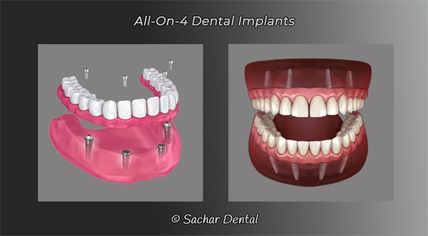 Dentist NYC all-on-4 dental implants Picture of All-on-4 dental implants two diagrams
