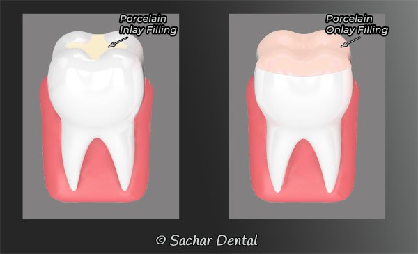 Dentist NYC Porcelain Fillings Dentist NYC for Inlays Onlays