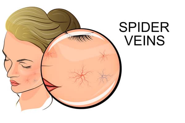 Facial-Thread-Vein-Removal