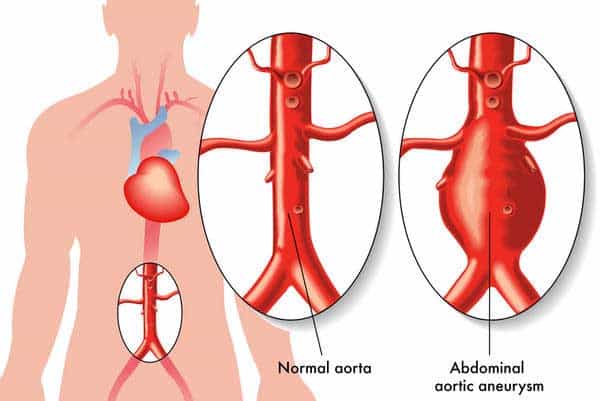 Abdominal-Aortic-Aneurysm-Picture