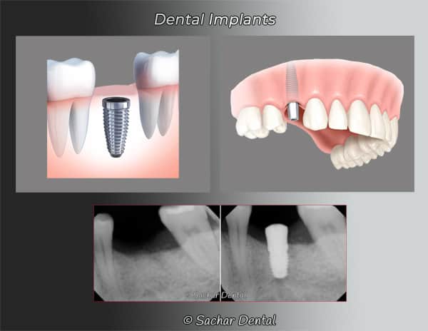 Dentist NYC dental implants Dental implants diagrams of implant, abutment, and crown