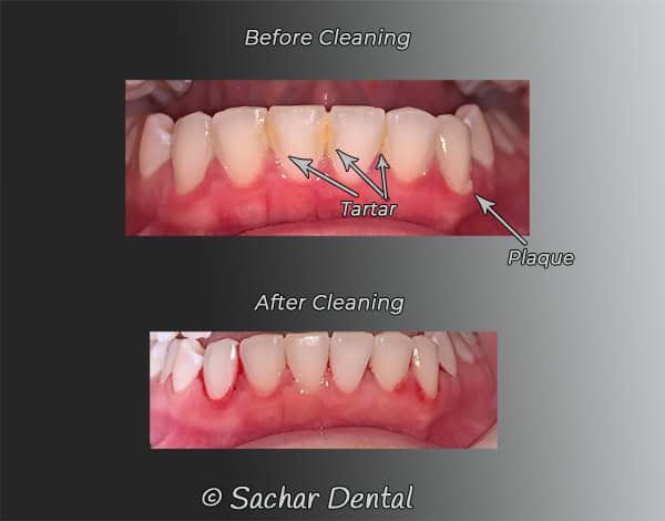 Before and after teeth cleaning at Sachar Dental NYC Dentist NYC for teeth cleaning