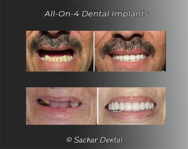 Dentist NYC dental implants all-on-4 Picture of before and after patients with all-on-4 dental implants, 2 different patients