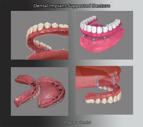 Picture of four diagrams of dental implants supported dentures