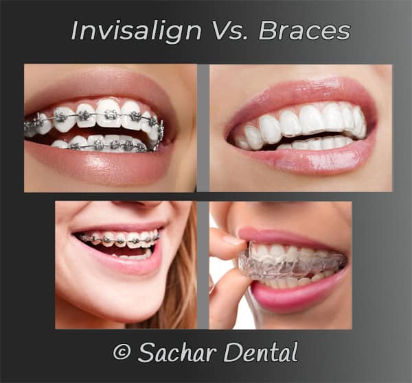 Picture of comparing metal braces to Invisalign