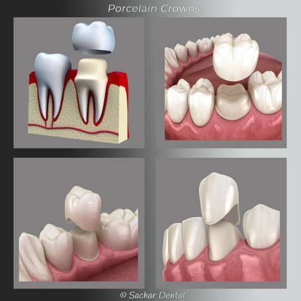 Top Cosmetic Dentist NYC for cosmetic porcelain crowns Cosmetic Dentist NYC - Porcelain crown diagram