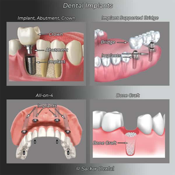Dentist NYC dental implants NYC Picture: Diagrams explaining dental implants including implants, abutment, crown, implant supported bridge, all on 4, bone grafting