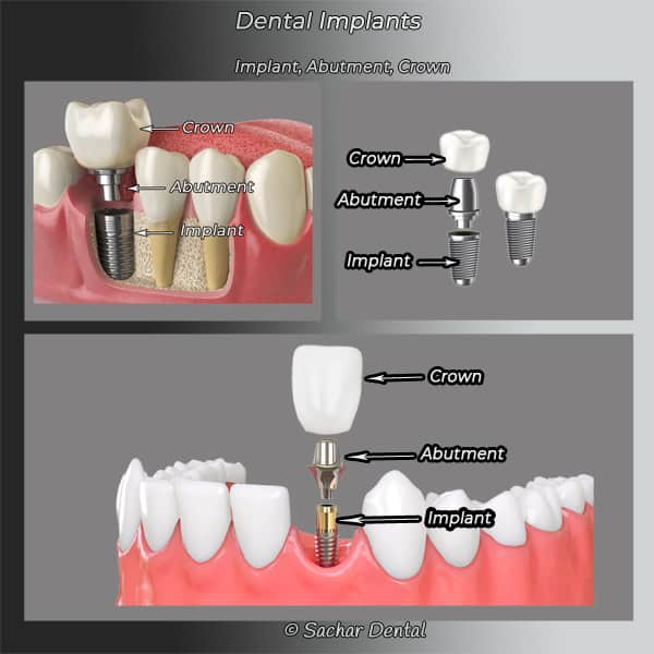 Dentist NYC NYC Dentist for Implant Crown