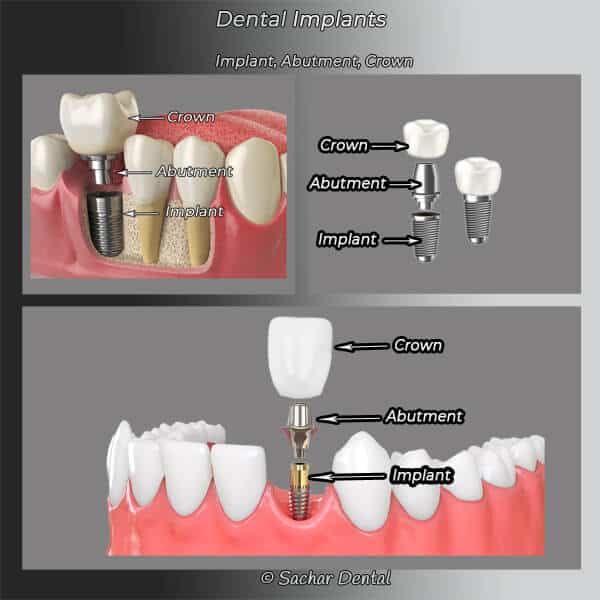NYC best dental implants Dental implant NYC blog