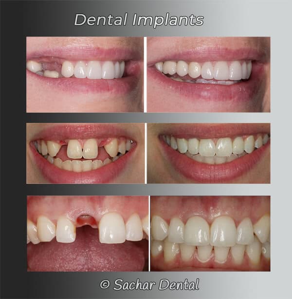 Dentist NYC dental implants Picture of 3 before and after pictures of patients who had dental implants