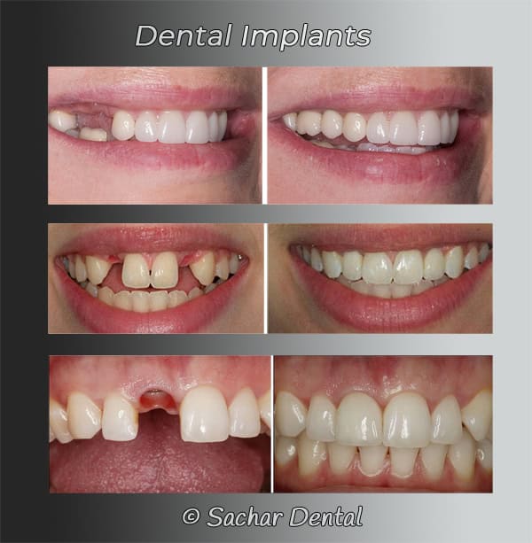 Dentist NYC for Dental Implants Sachar Dental NYC