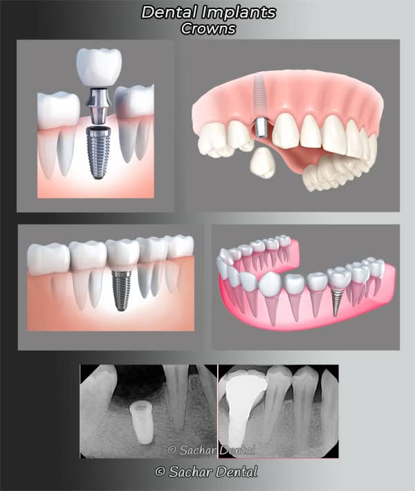 Dentist NYC dental implant crowns Picture of diagrams and x-ray of crowns attached to dental implants