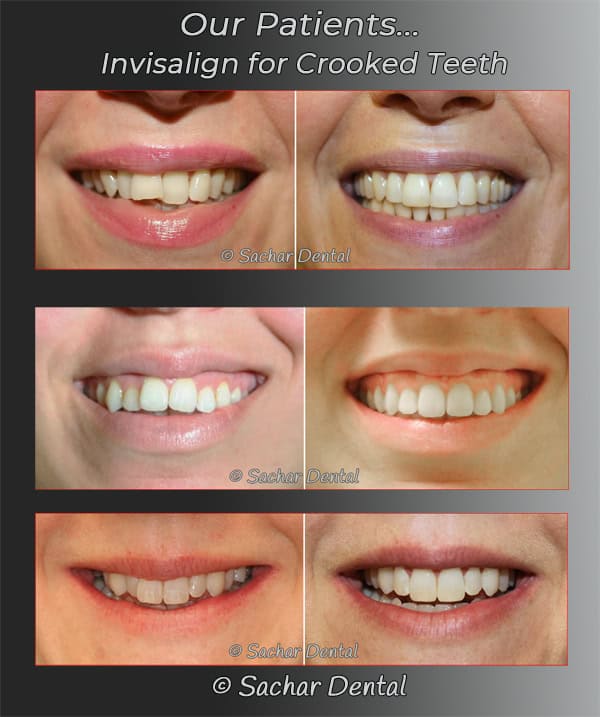 Dentist NYC, Invisalign for Crowded Teeth