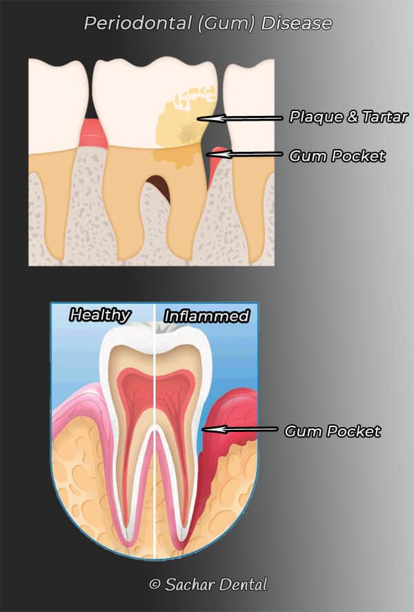 Dentist NYC periodontal disease Picture of diagram of periodontal disease, two pictures