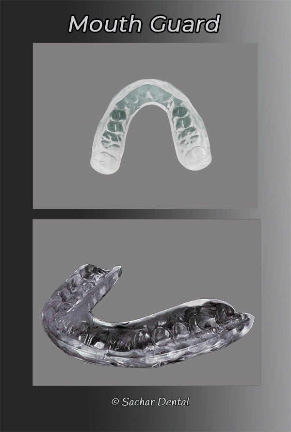 custom mouth guards Dentist NYC for Night guard
