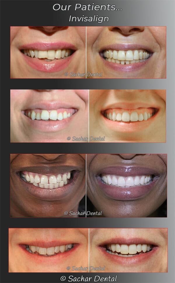 Dentist NYC Invisalign before and after Best Invisalign Dentist NYC
