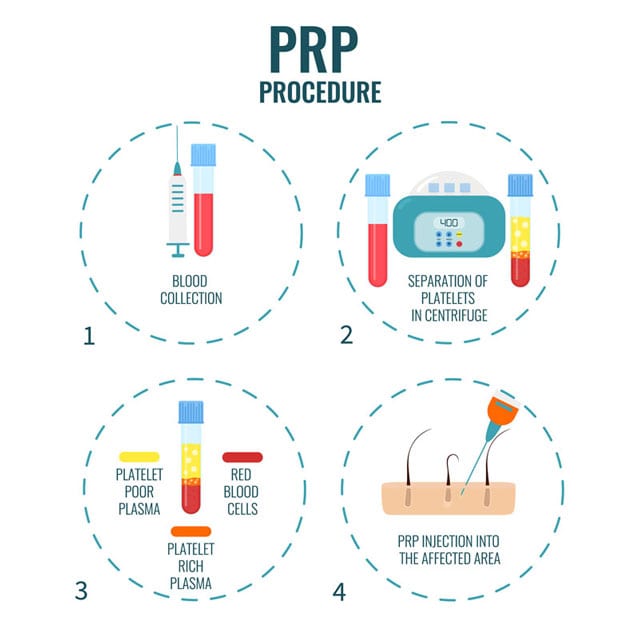 How-does-PRP-for-hair-loss-work