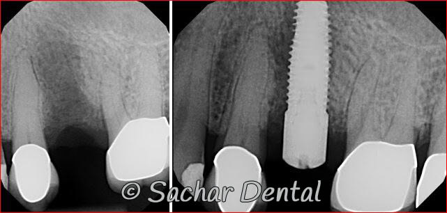 sinus lift bone graft dental implant Top Dental Implants NYC