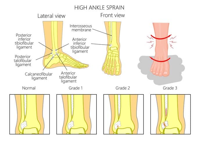 Sprained Ankle Are they all the same?? Evolve Sports Physio