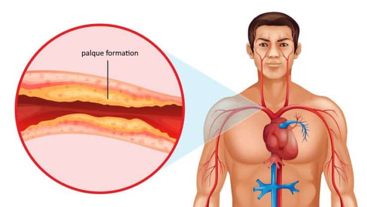 atherosclerosis - cholesterol plaque formation