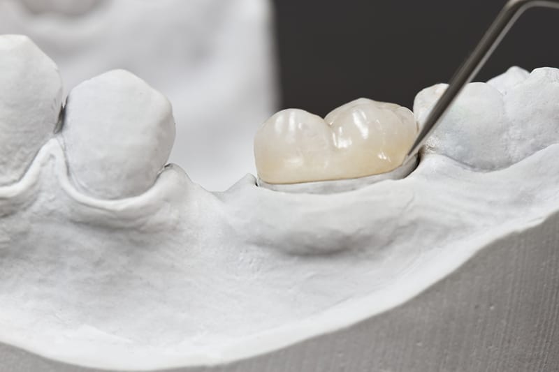 dental implant dallas texas