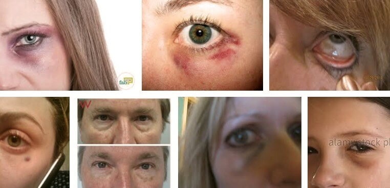 Goz Alti Morluklari Icin Hangi Bolume Gidilir Dr Erhan Yavuz