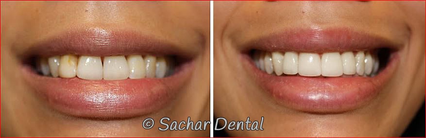 porcelain veneers NYC Porcelain veneers NYC