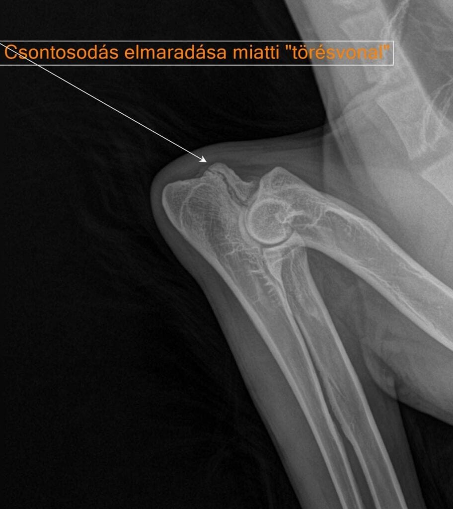 Izolált processus anconeus