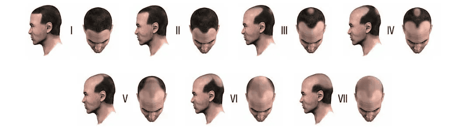Everything-you-need-to-know-about-hair-loss1