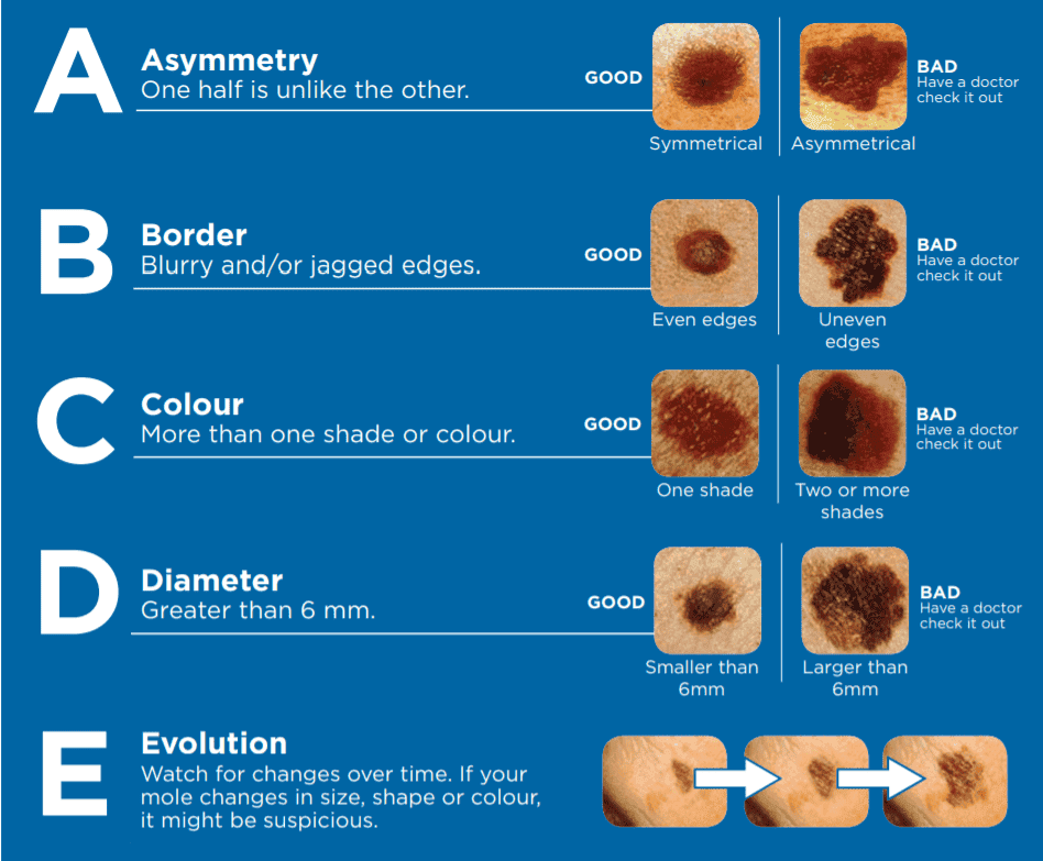 Research from the NCBI shows that patients with atypical mole syndrome have a 10.7% melanoma incidence over 10 years, compared to just 0.62% in control groups. People with 10+ atypical moles have a 12-fold higher risk of melanoma, according to the Skin Cancer Foundation. This risk increases with family history and certain genetic markers. It's worth noting that most moles never become cancerous. Even those with BRAFV600E mutations (common in moles) typically remain benign throughout life. The ABCDE Guide to Suspicious Moles Knowing when to seek professional assessment is crucial. The ABCDE method provides an easy way to identify potentially dangerous moles: