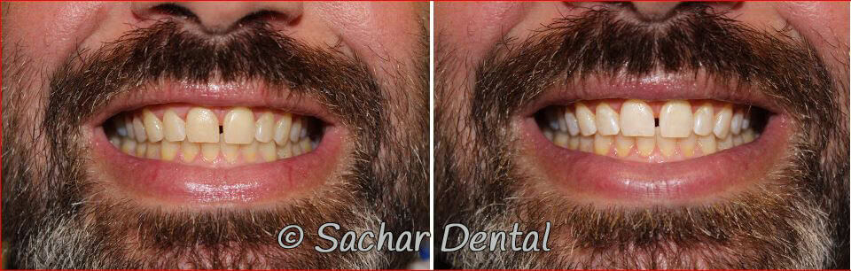 professional teeth whitening nyc Best NYC cosmetic dentist for teeth whitening. Before and after pictures of in office teeth whitening