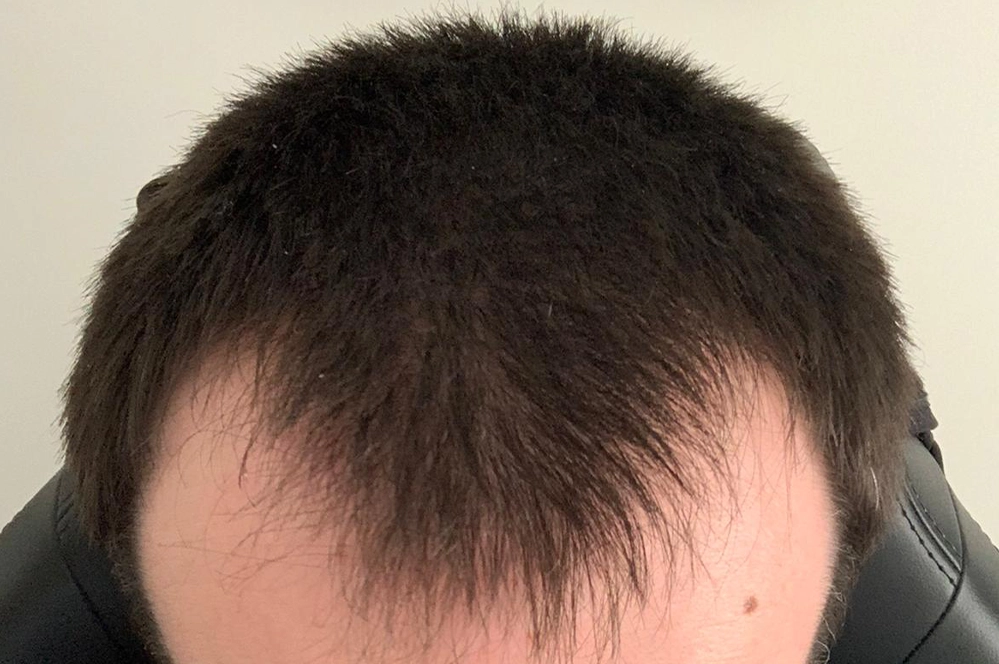 Photo of a man with a m shaped hairline