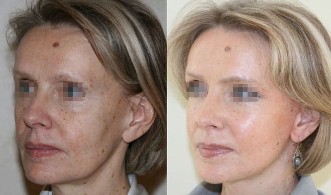 Подтяжка лица (фейслифтинг) 25