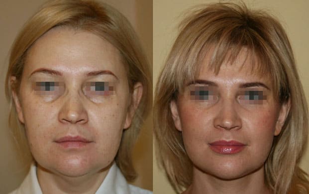 Подтяжка лица (фейслифтинг) 21